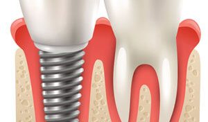 tooth-and-implant