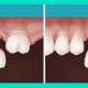 ایمپلنت یا بریج دندان